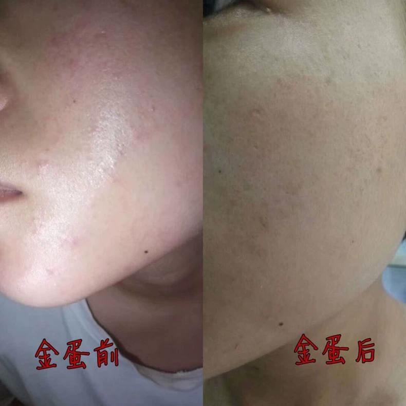 Bí quyết y học Trung Quốc Newwey với kem trị mụn trứng vàng nhỏ giúp làm sáng da mụn trứng cá kem trị mụn trứng cá nam nữ kem dưỡng ý dĩ