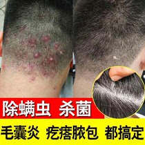 There are pimples on the head oil control special medicine head folliculitis special shampoo seborrheic dermatitis dandruff and itching