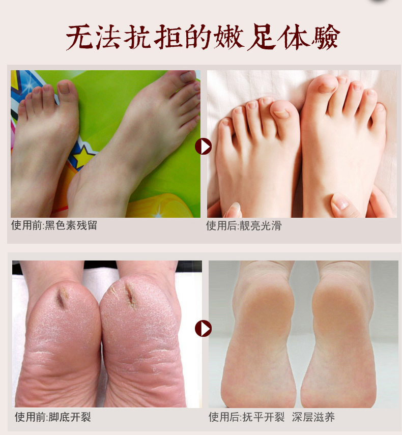 Chăm sóc bàn chân ba mảnh phù hợp với đôi chân dịu dàng trắng tẩy tế bào chết da chết chân cũ kem phim kem chà kem bôi bàn chân trị nẻ chân