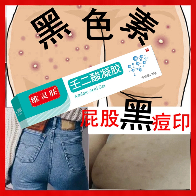Remove Black Marks from the Buttocks, Remove Black Acne Marks from the Back and Buttocks, Fade and Eliminate Acne Marks on the Back