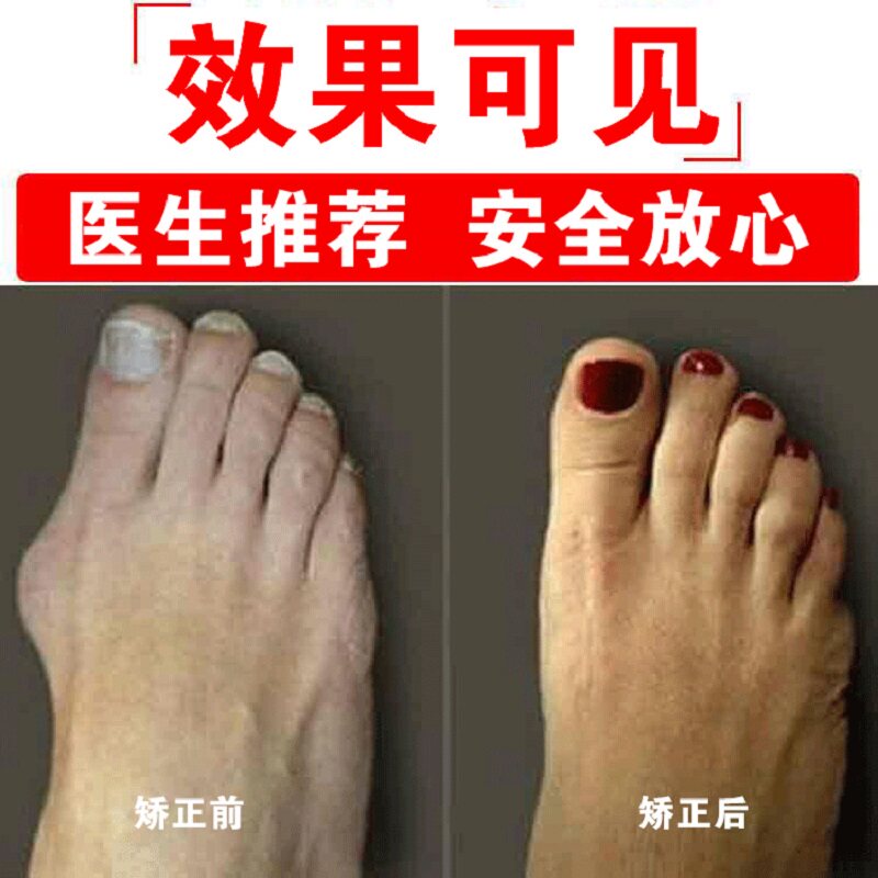Fushen thumb valgus appliance to your big foot bone bending Male and female health orthopedics also your delicate jade feet