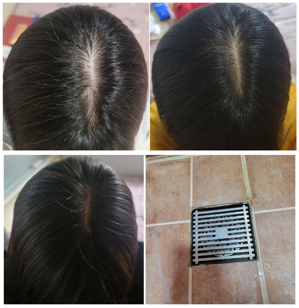 换洗发水后掉发加剧？这可能是你的头皮发出的信号