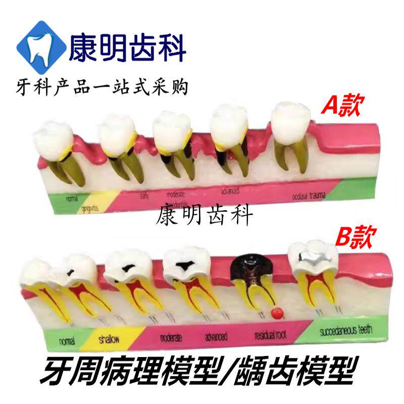 口腔模型牙科讲解教学模型龋齿病例模型医患沟通龋齿牙周病理模型