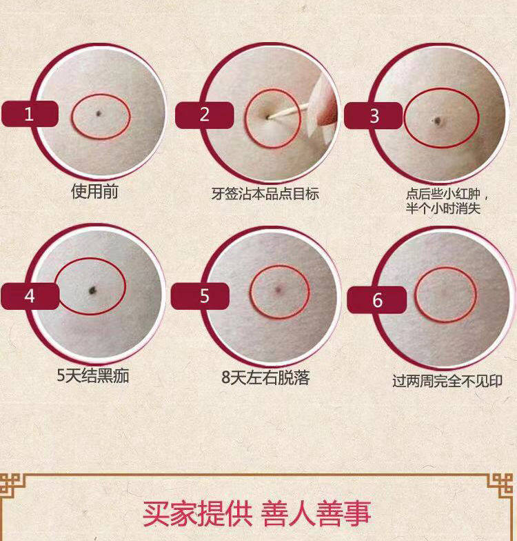 点脸部痣斑药水取雀斑净黑点遗传雀斑无痕美容院专用点痦子痣正品真的有用吗？_化妆_淘宝美妆网