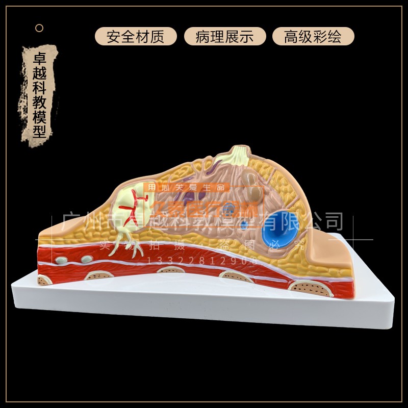 正品人体解剖模型 病理乳房病理哺乳模型 乳房病变模具 乳腺模型
