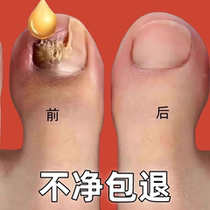 (Take one drop every day to easily remove gray potassium) No damage to good potassium painless replacement of new potassium remove bad potassium from hands and toes