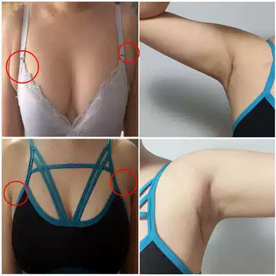 (Thousands of people witness)Sub-milk removal sub-milk artifact elimination lymph node node loose knot paste in addition to dredging armpit cream