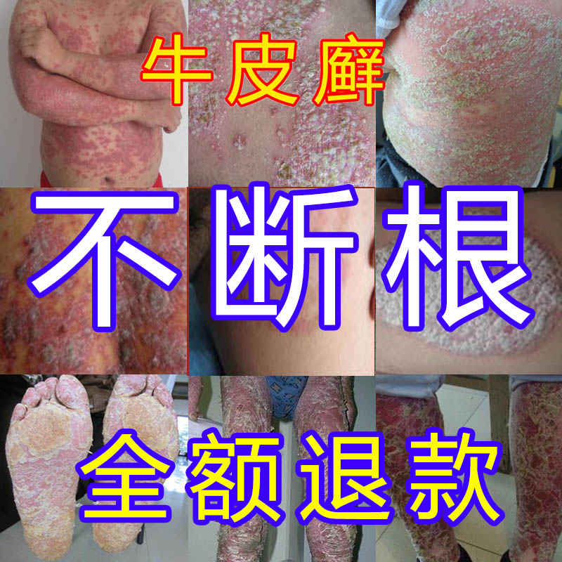 Treatment of stubborn neurodermatitis, eczema, itching, chronic psoriasis, moss, root and root, skin topical ointment