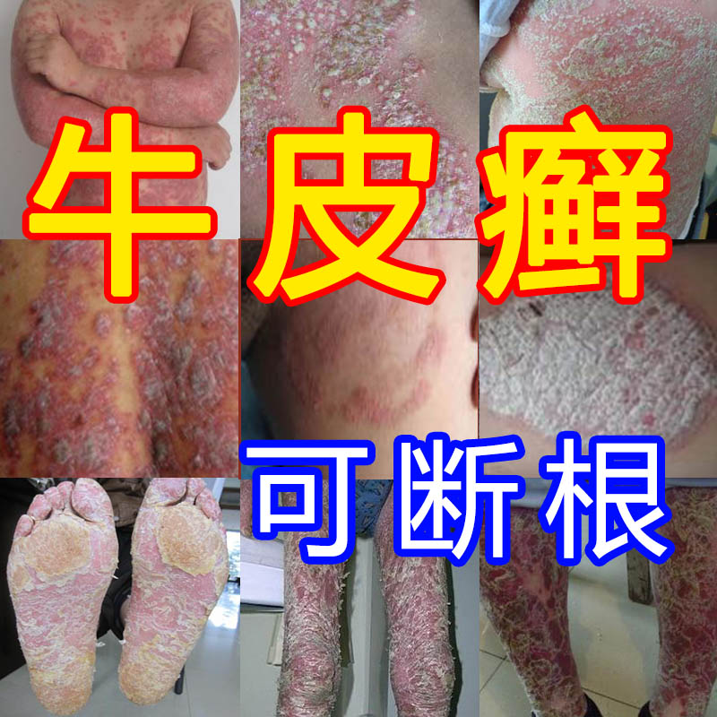 Treatment of stubborn neurodermatitis, eczema, itching, chronic psoriasis, root removal, skin topical ointment