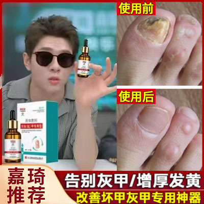 Healing Solution for Thickened and Hardened Toenails, Thickening and Yellowing of Toenails, Thickening and Yellowing of Toenails, Growth Solution, Gray Nail Magic Tool