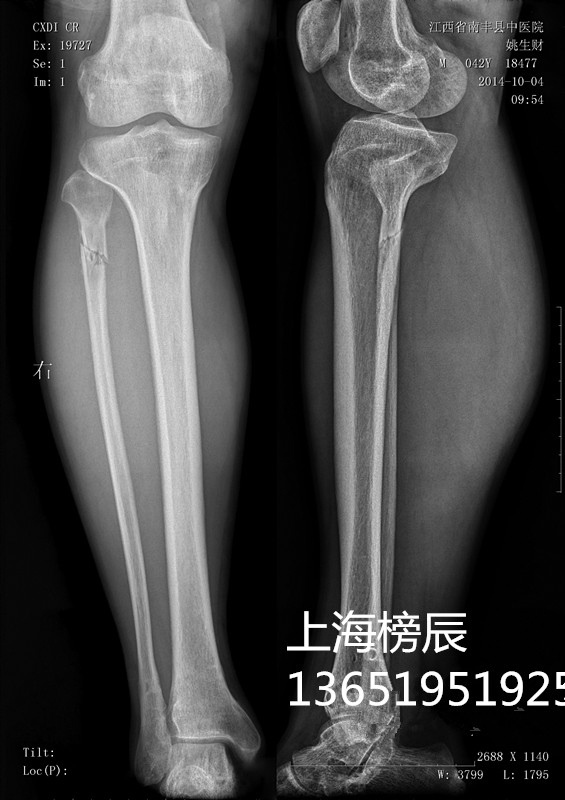 Porcelain white laser A3 A4 medical film radiology department dry swab x-ray CR DR CT double-sided printing 175um