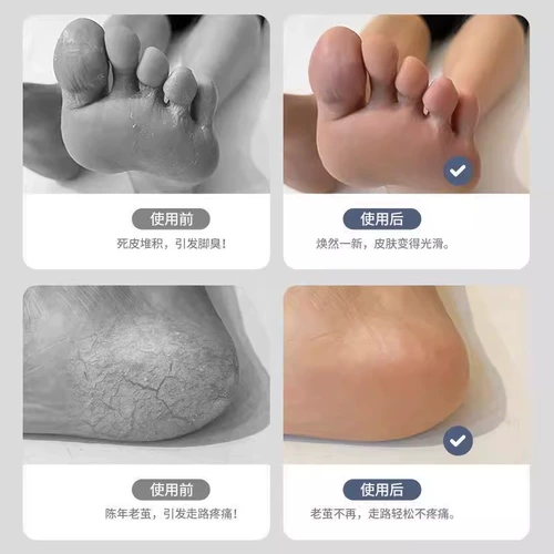 Артефакт -сжигание ноги, чтобы удалить ногу ноги ноги, пятки ног, восстановить камень в мозоли, возбужденная соскребая кожа и нога