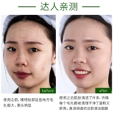 [Рекомендуется Wei Ya] Позвольте пор сбросить грязные вещи, такие как тужа, до поры на лице и мусор