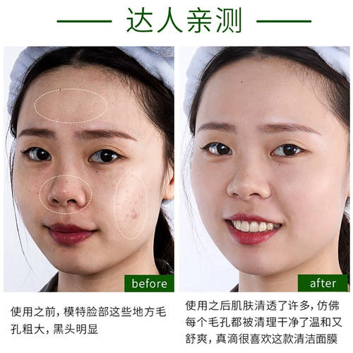 [Рекомендуется Wei Ya] Позвольте пор сбросить грязные вещи, такие как тужа, до поры на лице и мусор