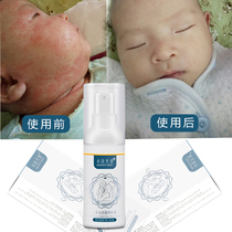  Baby dry wet baby face cream Newborn diaper diagnosis red butt allergy itching Baby treasure special care cream