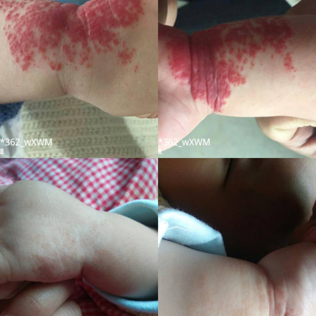 ຢາປິ່ນປົວເດັກນ້ອຍ Hemangioma vascular nevus cherry hemangioma ຄີມໃຊ້ພາຍນອກເພື່ອເອົາ spongy strawberry