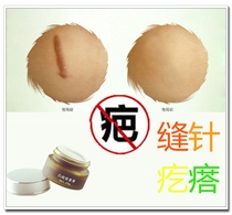 Repair burn scars spiritual constitution ointment to remove hypertrophic bumps raised ear holes and pimples for children.