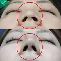 Li Jiaqi said goodbye to the ugly nose ~ the nose artifact and the collapse of the nose said goodbye