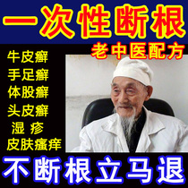 Cowhide antipruritic skin topical treatment of psoriasis fungal infection itching psoriasis head Moss special effect ringworm ointment