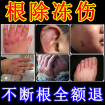 Frozen Sore Paste Antifreeze Injury Cream Antifreeze Root Effects Children Japan Hand Face Ear Fluid A Rag