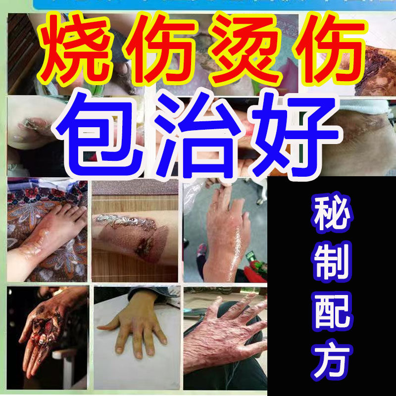 Burns and scald ointment external use children's baby boiled water hot oil fire burn blisters moist muscle-building oil medicine does not leave scars