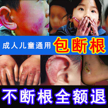 Snake Oil Freeze Sore Cream Cure Root Stop Itch Freeze Injury Cream Jelly Hand Face Ear Antifreeze Anti-Swelling Hand Cream