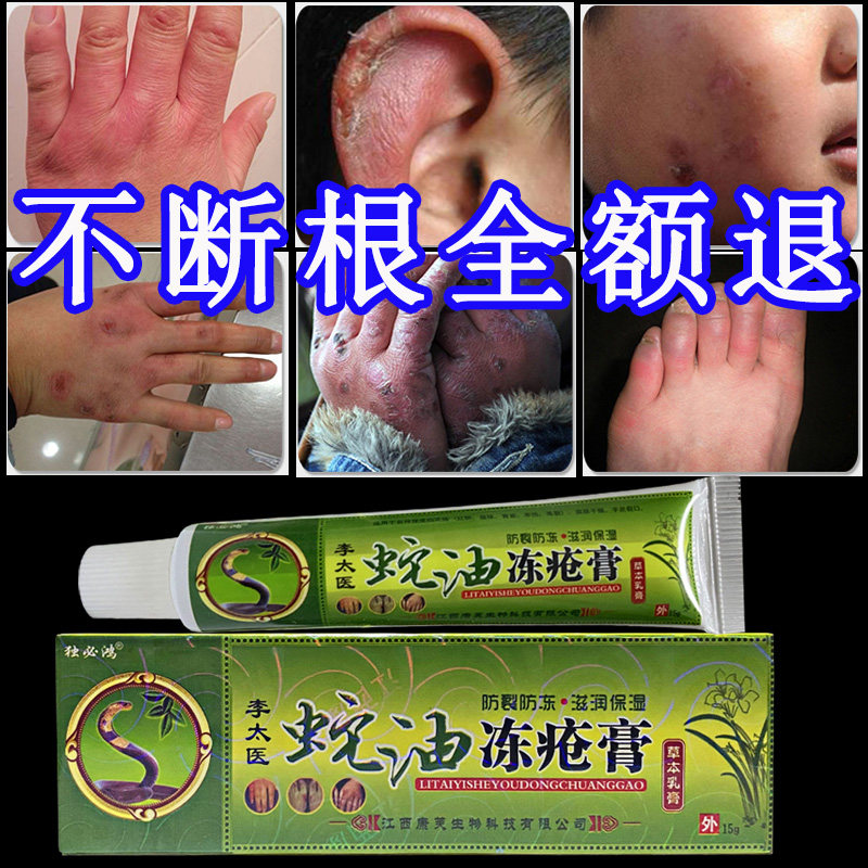 Lee Too Doctor Snake Oil Freeze Sore Cream Frostbite Cream Antifreeze Root Special Effects Children Hand Face Ears
