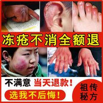 Frozen Hands Children Adult Baby Freeze Sore Cream Frostbite Cream Antifreeze Root Hands and feet Facial Babies