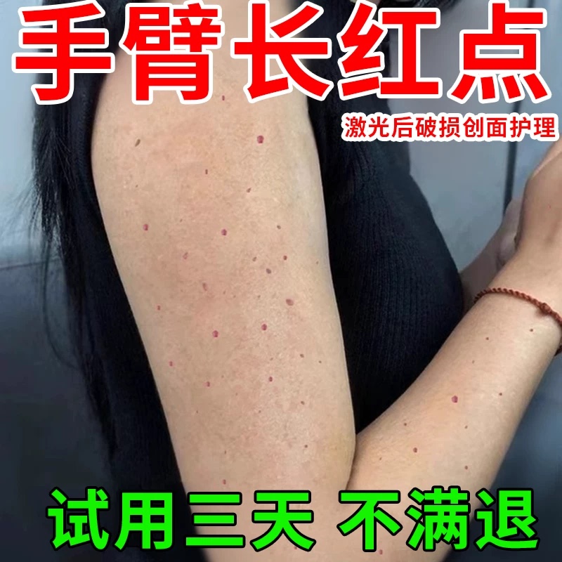Can Be Used with Vascular Tumor, Vascular Mole, Cherry-Shaped Moles, Small Red Dot Moles on the Upper Arm, and Wound Care Gel Yu