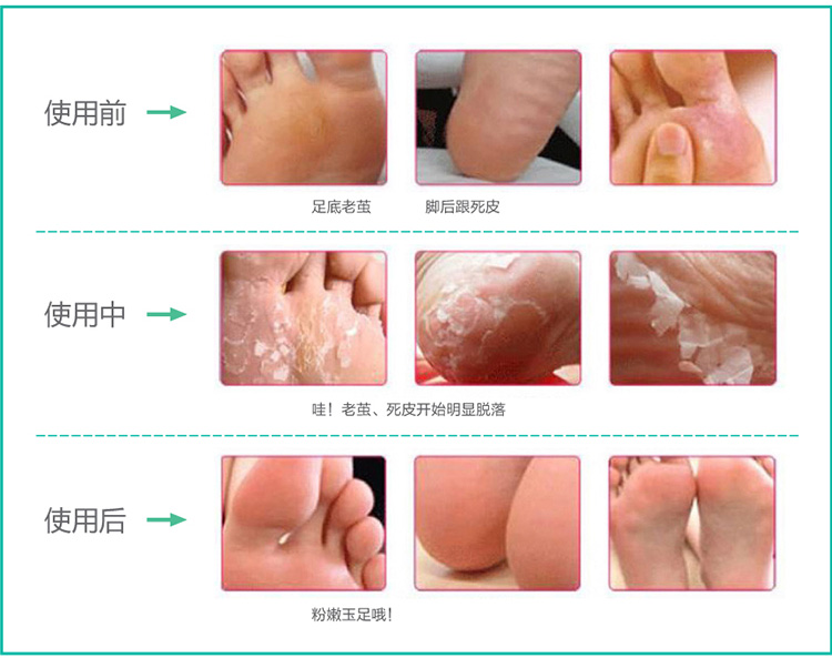 Mua 2 tóc 4 chân phim để chết da chết cũ dịu dàng chân gót chân khô nứt chân chân chăm sóc bàn chân chân lột mặt nạ chân trị nẻ chân