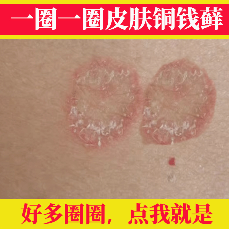 A Rash of Red Bumps and Moss-Like Patches All over the Body, Including the Calves, Arms, Buttocks, and Private Areas, with Itchy Skin A Rash of Red Bumps and Moss-Like Patches All over the Body, Including the Calves, Arms, Buttocks, and Private Areas, with Itchy Skin