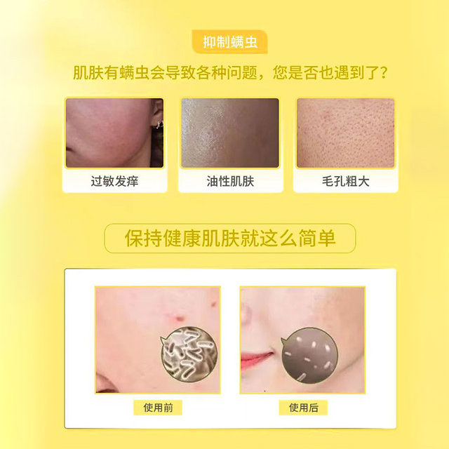 Sulfur facial cleanser removes mites, removes acne, deep cleanses, oil-controls and acne muscle facial soap, special facial cleanser for women and men