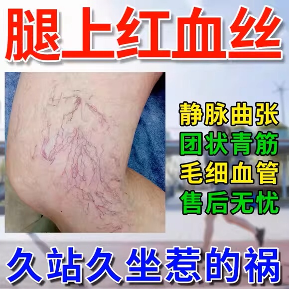 Specialized Ointment for Treating Varicose Veins, Specifically for Leg Veins That Are Raised and Swollen, Varicose Veins Gel, Cold Compress Gel for Varicose Veins, Medicine for Leg Veins That Are Raised, Specialized for Chronic Leg Conditions, Red Blood Streaks, and Raised Veins Specialized Ointment for Treating Varicose Veins, Specifically for Leg Veins That Are Raised and Swollen, Varicose Veins Gel, Cold Compress Gel for Varicose Veins, Medicine for Leg Veins That Are Raised, Specialized for Chronic Leg Conditions, Red Blood Streaks, and Raised Veins