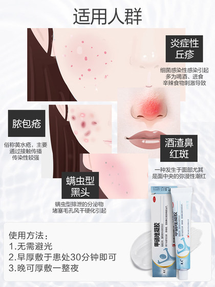 clotrimazole cream for rosacea