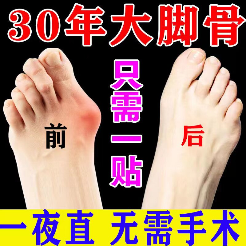 Thumb valgus paste thumb valgus correction artifact big foot bone toe deformity overlapping joint deformation special paste