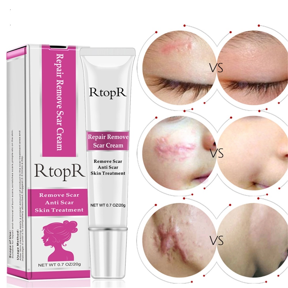 Acne Scar Removal Cream Image 2