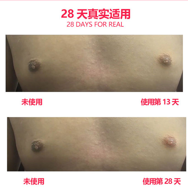 私处乳晕腋下去黑色素沉淀美白变粉嫩外阴淡化阴道护理精油嫩红素