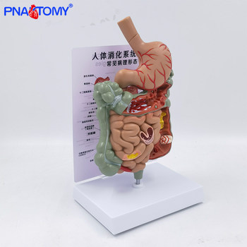 Pathological Digestive System Model, Gastric Section, Large Intestine, Small Intestine Anatomy Model, Medical Display, Teaching Explanation, Science Popularization