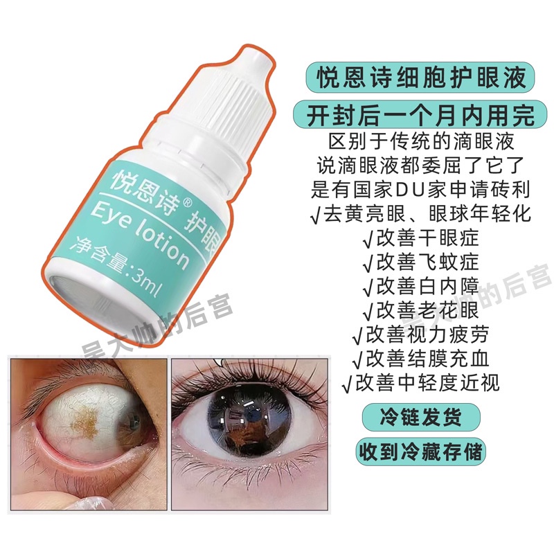 Big Treasure! Shipped through Cold Chain! Yue En Shi Eye Drops, Eye Care Solution, Improves Yellowing of the Eyeball, Dry Eyes, and Red Bloodshot Eyes