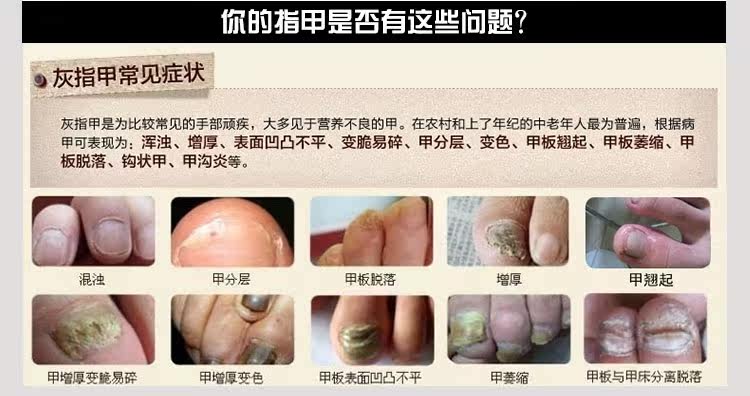 京顺堂卉甲净ticd草本抗菌膜佳季益本灰甲套装 女装 流行女装 爱冲锋衣