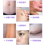 Импортированный медицинский kim bark scar cream scar post remorge hirge face perm, обмягченные шрамы подлинного геля