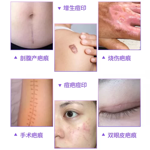 Импортированный медицинский kim bark scar cream scar post remorge hirge face perm, обмягченные шрамы подлинного геля