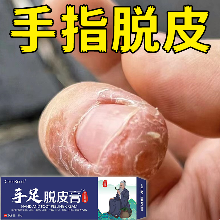 Hand and Foot Peeling Cream for Fingers, Dry and Cracked Nail Edges, and Scabs; Anti-Hangnail Repair Cream for Children Hand and Foot Peeling Cream for Fingers, Dry and Cracked Nail Edges, and Scabs; Anti-Hangnail Repair Cream for Children