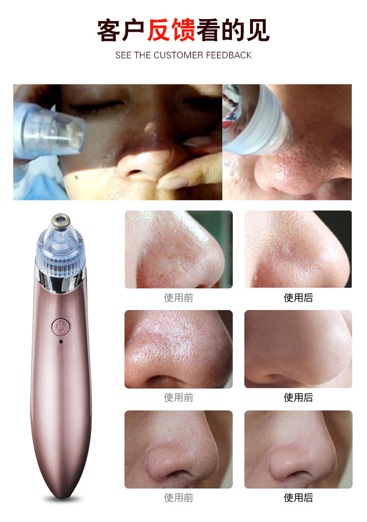 Blackhead Beauty Instrument_10