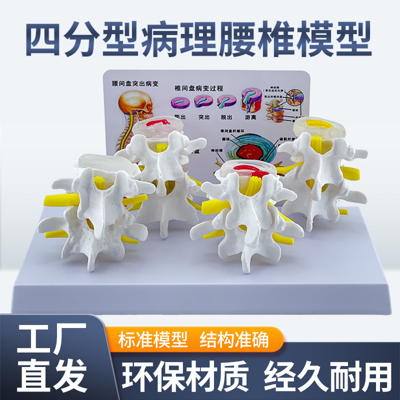 教学仿真病理脊椎模型四分型脊椎正常与病变腰椎组合模型人体脊椎