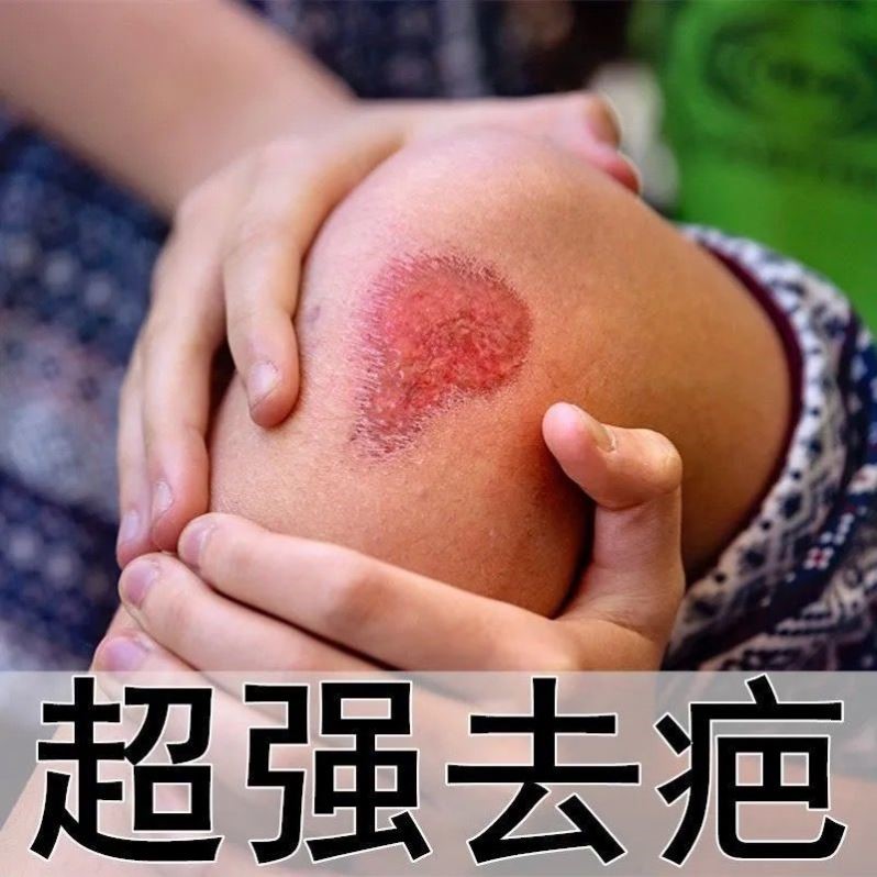 Scar cream hyperplasia repair surgery No trace on the face Old scar scar fall injury scalding artifact Acne print Stretch marks