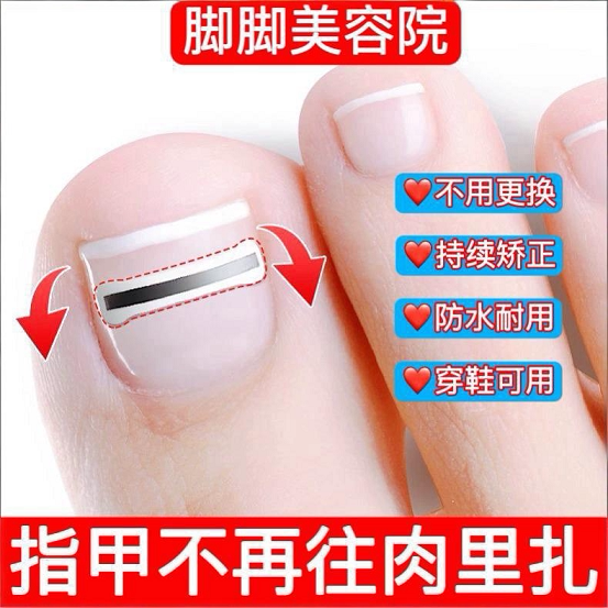 Ingrown Toenail Corrector, Titanium Alloy Splint for Correcting Ingrown Toenails, Special Tool for Toenail Inflammation That Grows into the Flesh, Day and Night Solution Ingrown Toenail Corrector, Titanium Alloy Splint for Correcting Ingrown Toenails, Special Tool for Toenail Inflammation That Grows into the Flesh, Day and Night Solution
