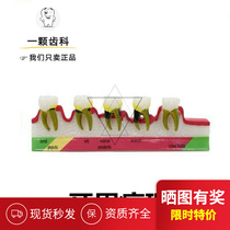 dental model periodontal pathological classification model oral model periodontal model pathological model