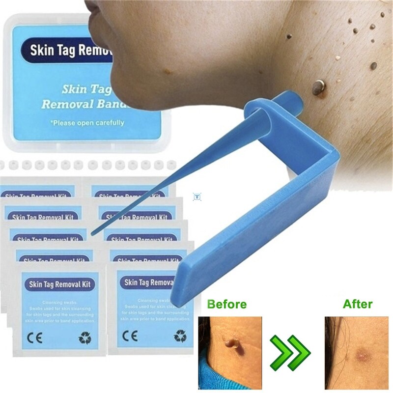 Medical micro skin tag remover Skin Mole Wart Remover Micro