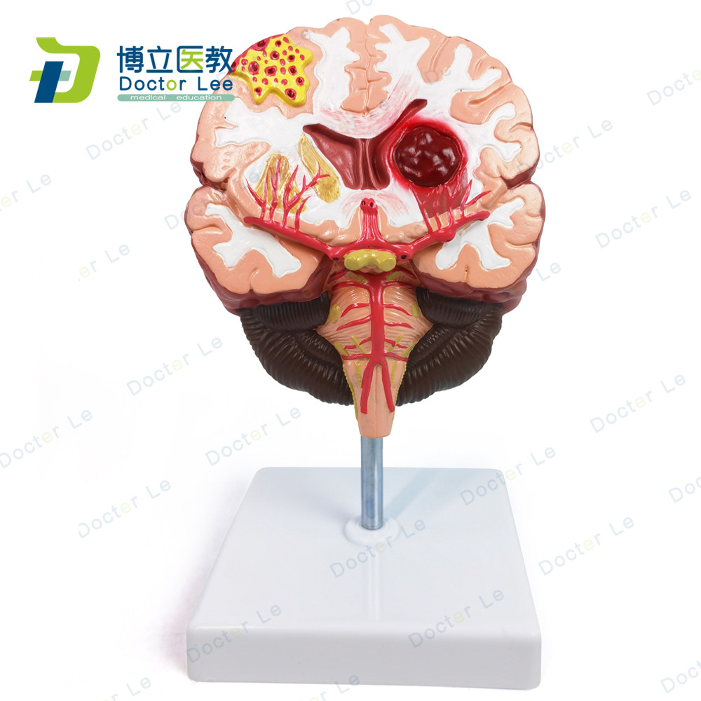 人体脑解剖 脑病理疾病 脑病理 构造 脑（血管） 病变脑模型